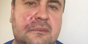 У Рівному кастетом побили забудовника та депутата міської ради від Радикальної партії Ляшка