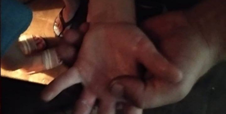 У Сарнах в дитини застряг палець у металевому отворі дверей (ФОТО)