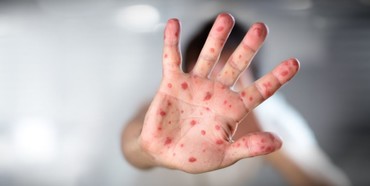 На Рівненщині через відсутність щеплень серйозні спалахи інфекційних захворювань