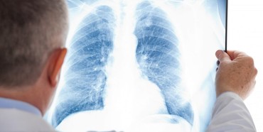 У Рівненській області зменшується кількість хворих на туберкульоз