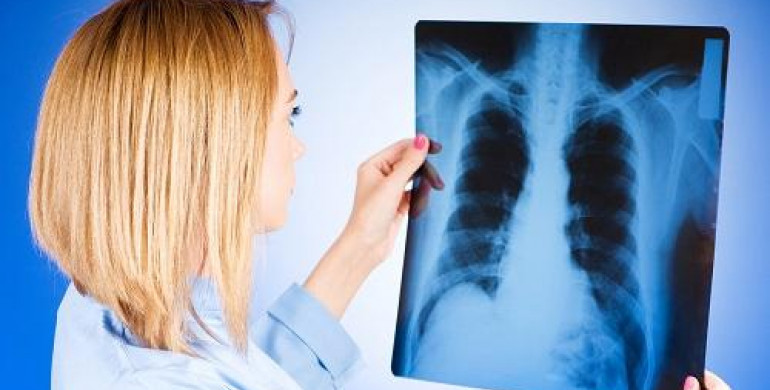 Туберкульоз на Рівненщині: експерти розповіли де найбільше хворих