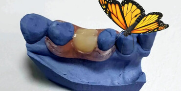 Коли застосовують зубний протез метелик і в чому його переваги: розбираємося в технології